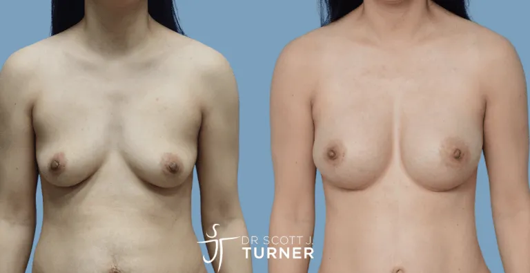 Asian Breast Augmentation, Anatomical High Profile Implants, Customized Dual Plane Placement, Photos Taken at 12 months Postoperatively (Patient also underwent an abdominoplasty)