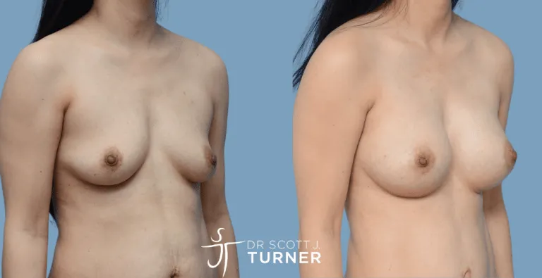 Asian Breast Augmentation, Anatomical High Profile Implants, Customized Dual Plane Placement, Photos Taken at 12 months Postoperatively (Patient also underwent an abdominoplasty)