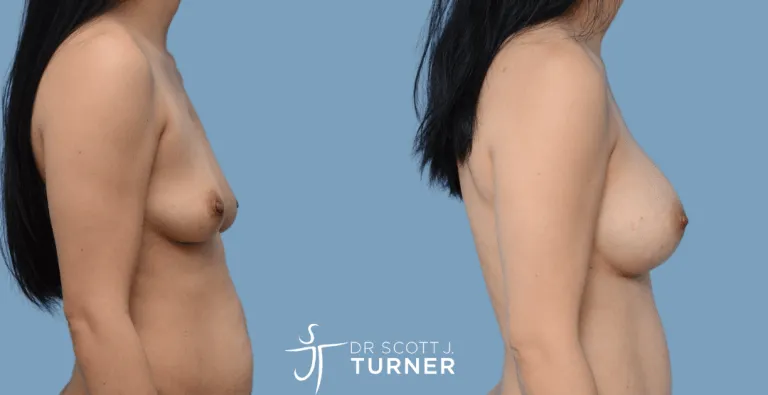 Asian Breast Augmentation, Anatomical High Profile Implants, Customized Dual Plane Placement, Photos Taken at 12 months Postoperatively (Patient also underwent an abdominoplasty)