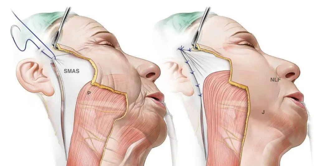 High-SMAS-Facelift-1024x533.jpg.webp Илюстрация на техниката на Preservation Deep Plane Facelift (www.leventefe.com.au)
