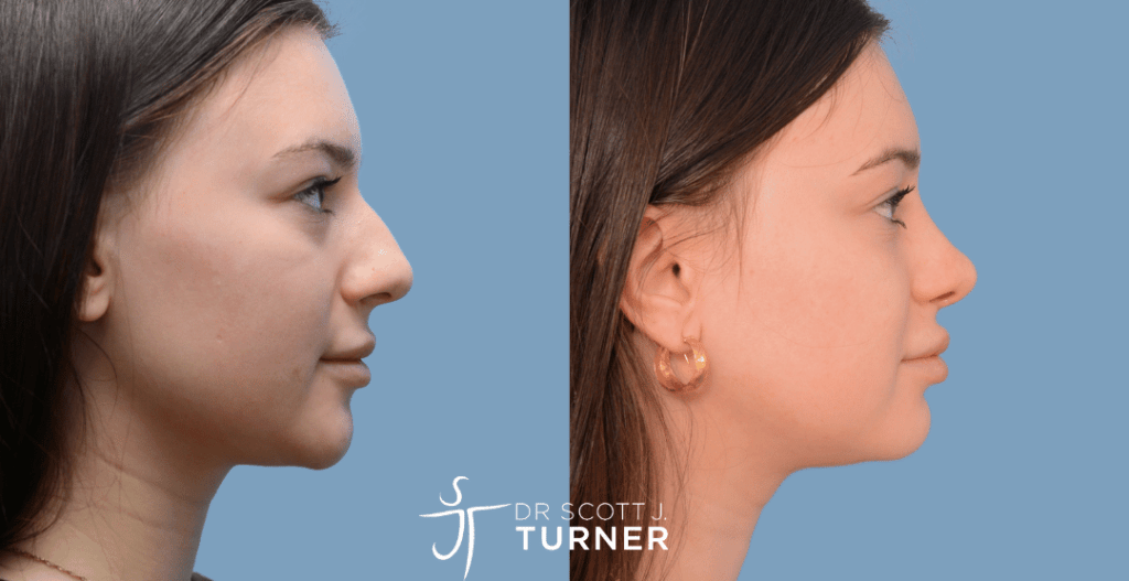 Functional Rhinoplasty - Correct Deviated Septum, Septoplasty, Dorsal Hump Reduction, Refine Tip Position