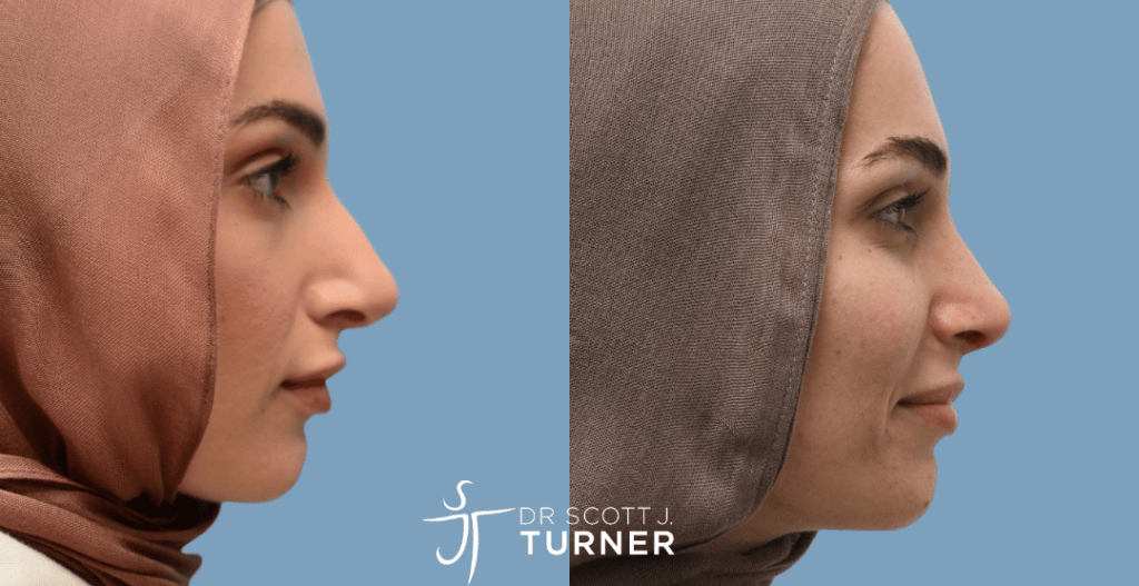 Primary Rhinoplasty - Dorsal Hump Reduction, Tip Refinement