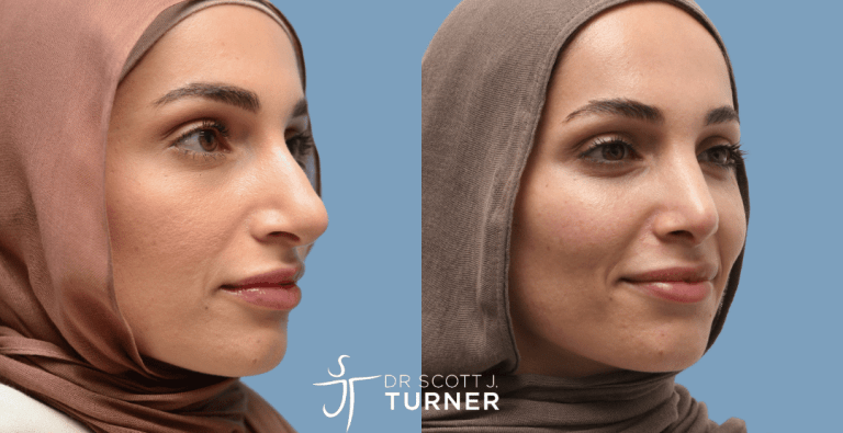 Primary Rhinoplasty - Dorsal Hump Reduction, Tip Refinement