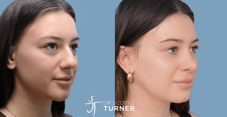 Functional Rhinoplasty - Correct Deviated Septum, Septoplasty, Dorsal Hump Reduction, Refine Tip Position