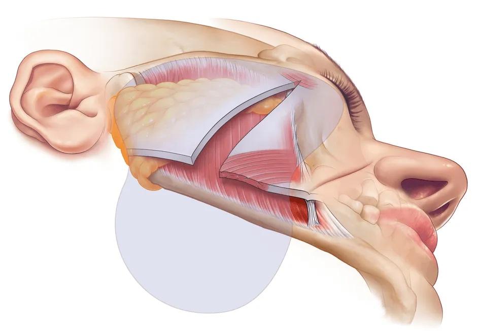 SMASectomy Facelift Technique