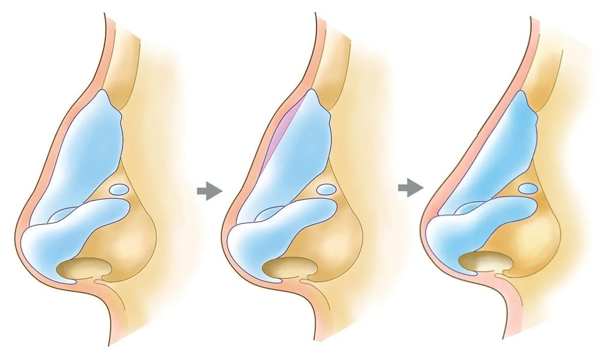 Dorsal Hump Reduction - Rhinoplasty