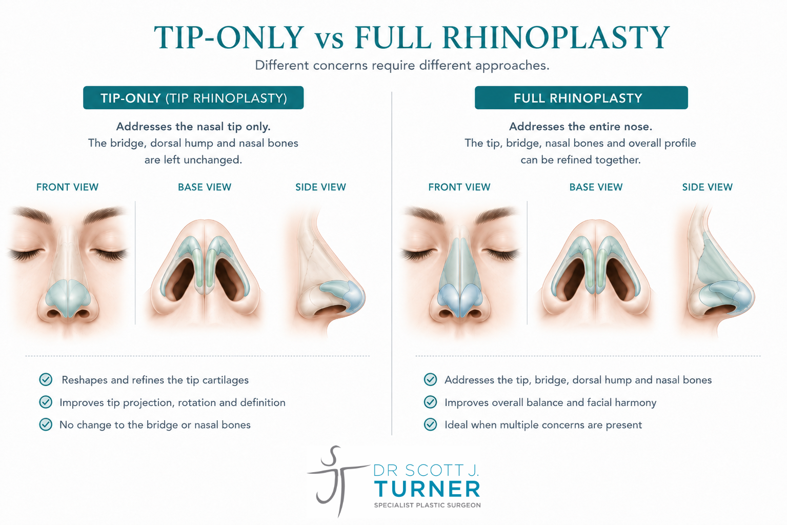 Mini Nose Job or Tip Rhinoplasty? Which Is Right?