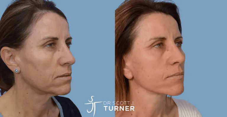 Short Scar Face Lift, SMAS Plication