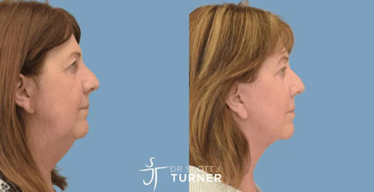 Face & Neck Lift, SMAS Plication, Platysmaplasty, Upper & Lower Blepharoplasty