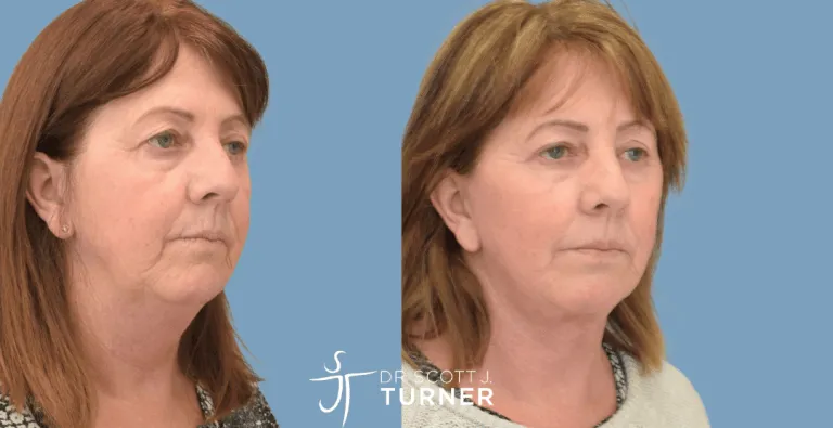Face & Neck Lift, SMAS Plication, Platysmaplasty, Upper & Lower Blepharoplasty
