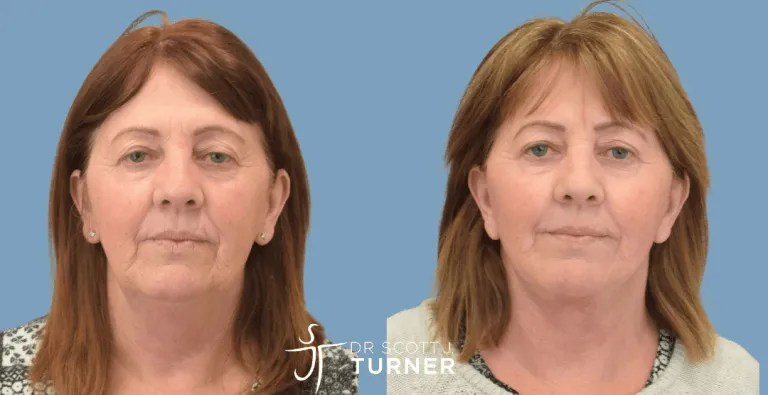 Face & Neck Lift, SMAS Plication, Platysmaplasty, Upper & Lower Blepharoplasty