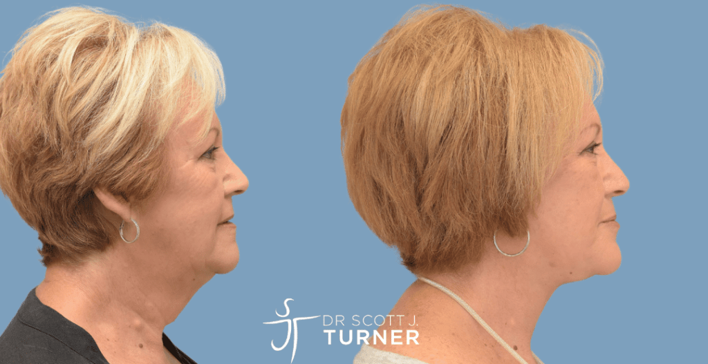 Face & Neck Lift, High SMAS Plication, Platysmaplasty