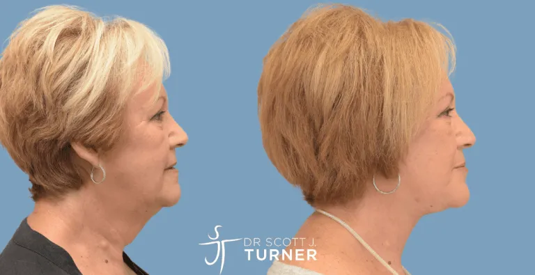 Face & Neck Lift, High SMAS Plication, Platysmaplasty