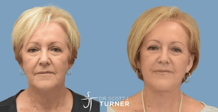 Face & Neck Lift, High SMAS Plication, Platysmaplasty