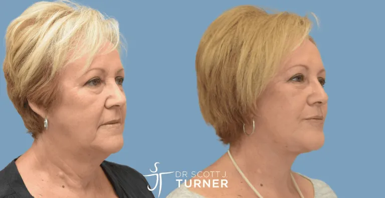 Face & Neck Lift, High SMAS Plication, Platysmaplasty