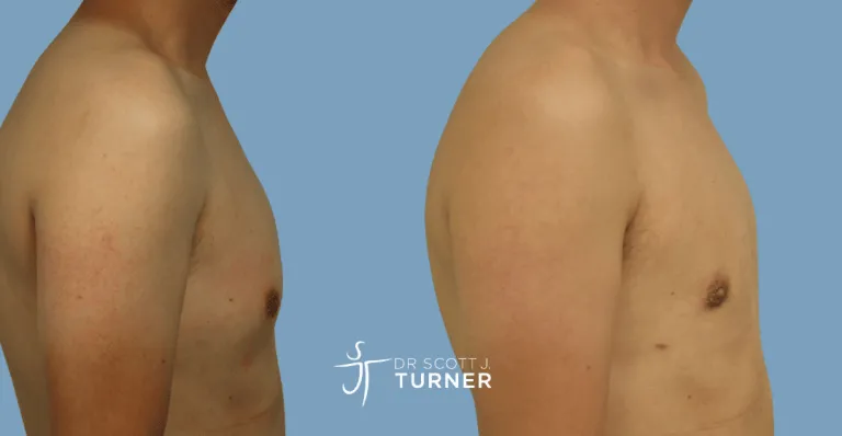 Bilateral gynaecomastia, gland excision and liposuction. Photos taken at 3 months postoperatively