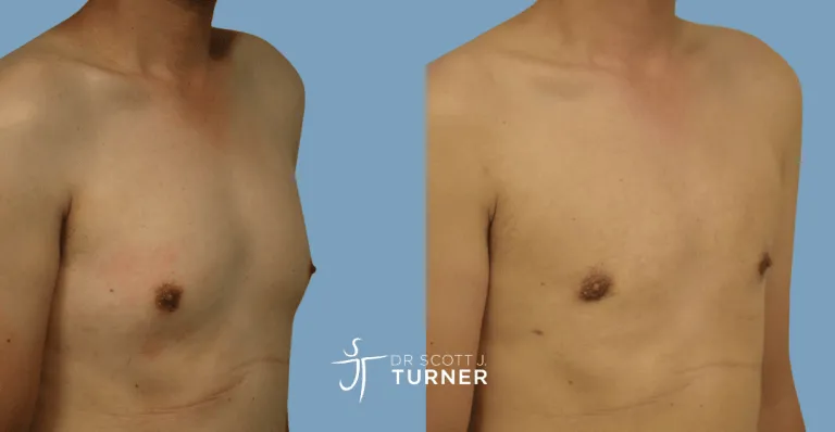 Bilateral gynaecomastia, gland excision and liposuction. Photos taken at 3 months postoperatively