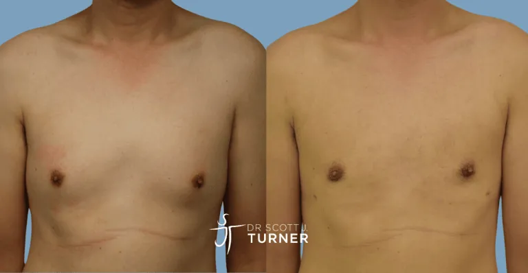 Bilateral gynaecomastia, gland excision and liposuction. Photos taken at 3 months postoperatively