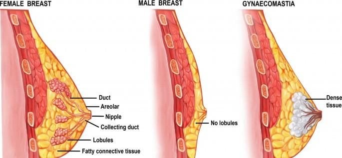 Gynaecomastia