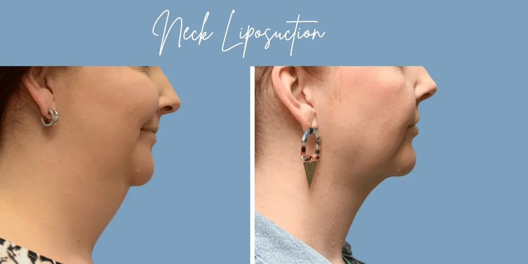 Neck Liposuction