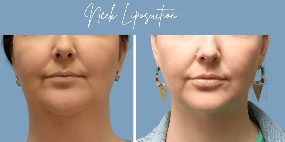 Neck Liposuction