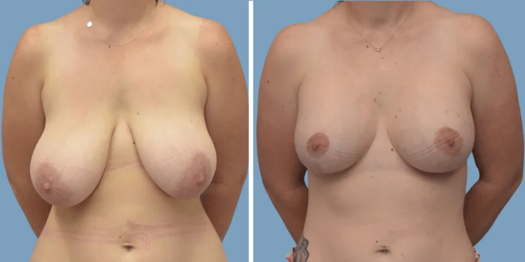 Breast Lift with Implants