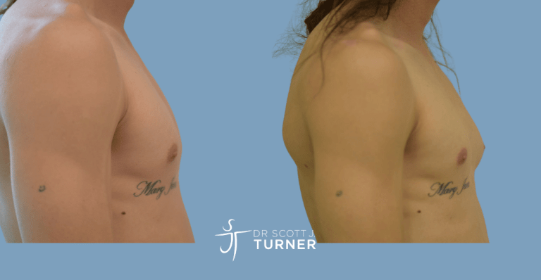 Left side gynaecomastia, direct gland excision, Photos taken at 3months postoperatively