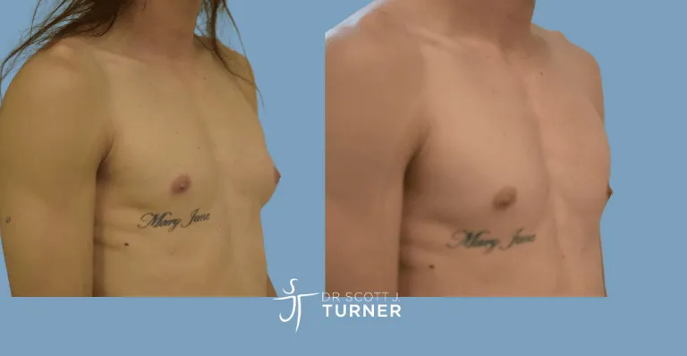 Left side gynaecomastia, direct gland excision, Photos taken at 3months postoperatively