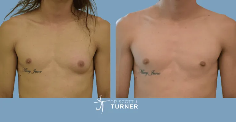 Left side gynaecomastia, direct gland excision, Photos taken at 3months postoperatively