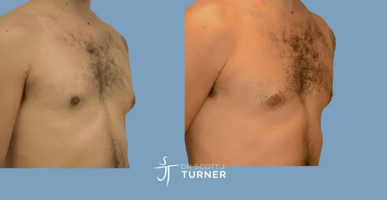 Bilateral gynaecomastia, gland excision and liposuction. Photos taken at 6 months postoperatively