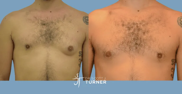Bilateral gynaecomastia, gland excision and liposuction. Photos taken at 6 months postoperatively
