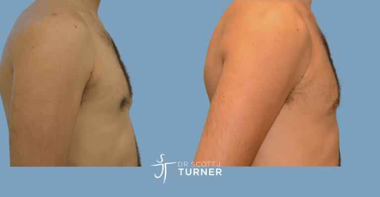 Bilateral gynaecomastia, gland excision and liposuction. Photos taken at 6 months postoperatively