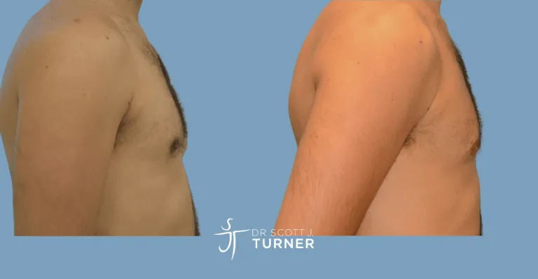 Bilateral gynaecomastia, gland excision and liposuction. Photos taken at 6 months postoperatively