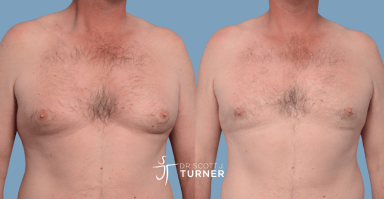 Bilateral gynaecomastia, gland excision and liposuction. Photos taken at 6 months postoperatively
