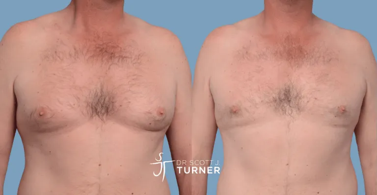 Bilateral gynaecomastia, gland excision and liposuction. Photos taken at 6 months postoperatively