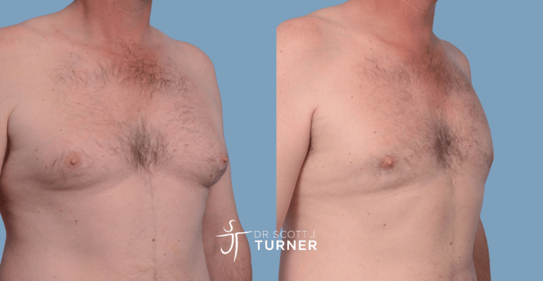 Bilateral gynaecomastia, gland excision and liposuction. Photos taken at 6 months postoperatively