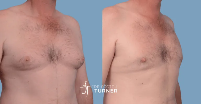 Bilateral gynaecomastia, gland excision and liposuction. Photos taken at 6 months postoperatively