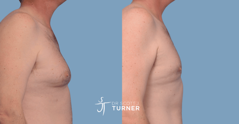 Bilateral gynaecomastia, gland excision and liposuction. Photos taken at 6 months postoperatively