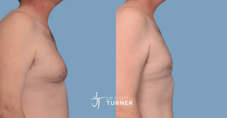 Bilateral gynaecomastia, gland excision and liposuction. Photos taken at 6 months postoperatively