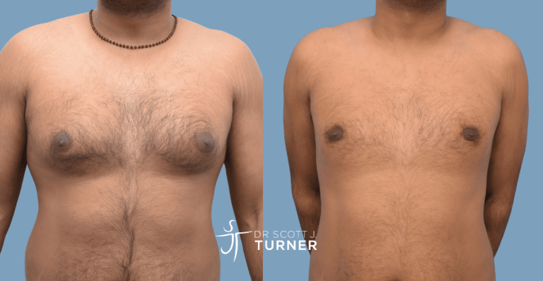 Bilateral gynaecomastia, gland excision and liposuction. Photos taken at 9 months postoperatively