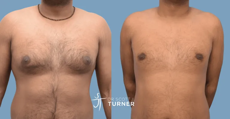 Bilateral gynaecomastia, gland excision and liposuction. Photos taken at 9 months postoperatively