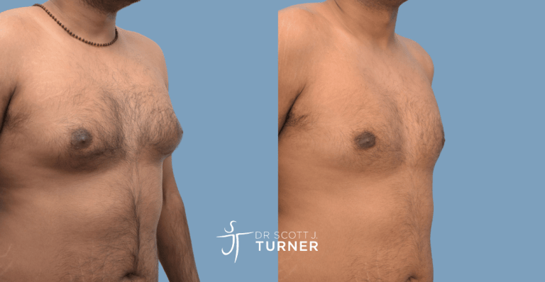 Bilateral gynaecomastia, gland excision and liposuction. Photos taken at 9 months postoperatively