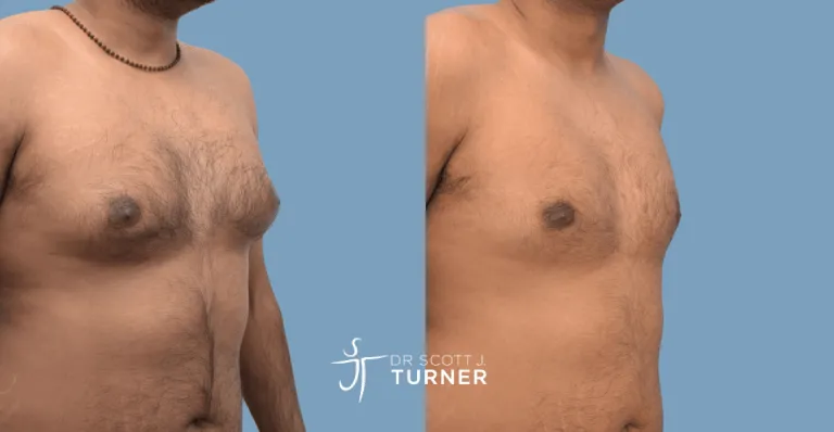 Bilateral gynaecomastia, gland excision and liposuction. Photos taken at 9 months postoperatively