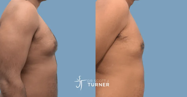 Bilateral gynaecomastia, gland excision and liposuction. Photos taken at 9 months postoperatively