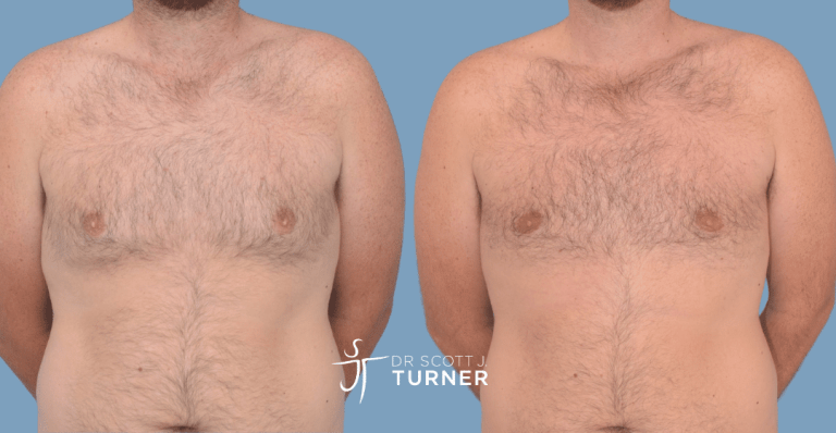 Bilateral gynaecomastia, gland excision and liposuction. Photos taken at 2 months postoperatively