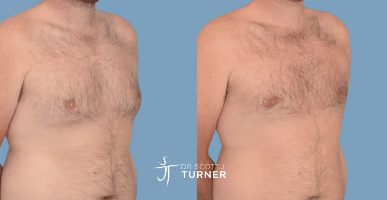 Bilateral gynaecomastia, gland excision and liposuction. Photos taken at 2 months postoperatively