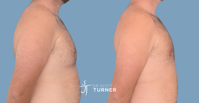 Bilateral gynaecomastia, gland excision and liposuction. Photos taken at 2 months postoperatively