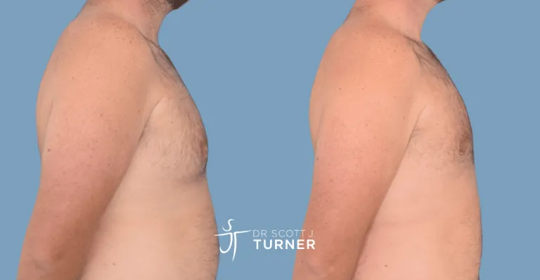 Bilateral gynaecomastia, gland excision and liposuction. Photos taken at 2 months postoperatively