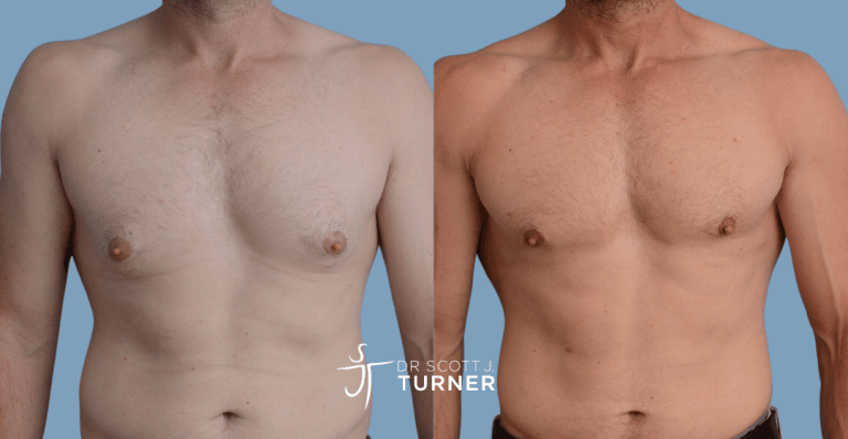 Bilateral gynaecomastia, gland excision and liposuction. Photos taken at 6 months postoperatively