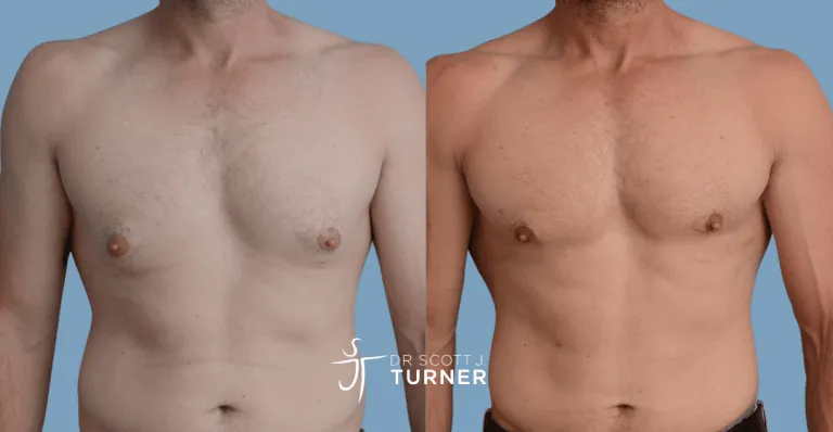Bilateral gynaecomastia, gland excision and liposuction. Photos taken at 6 months postoperatively